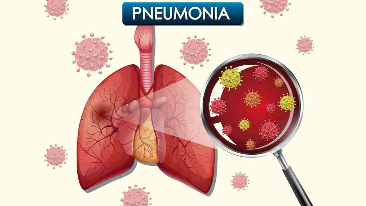 Pneumonia Nimonia compressed